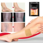 Patch de traitement des varices
