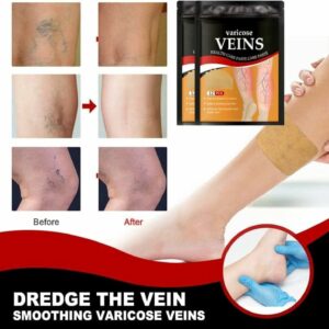 Patch de traitement des varices