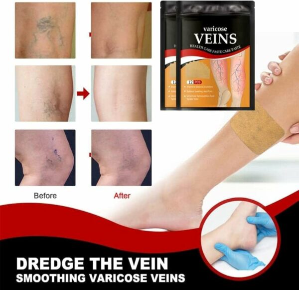 Patch de traitement des varices