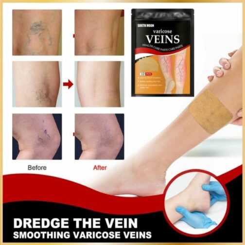 Patch Varices Naturel – Soulagement & Circulation (12 pcs)
